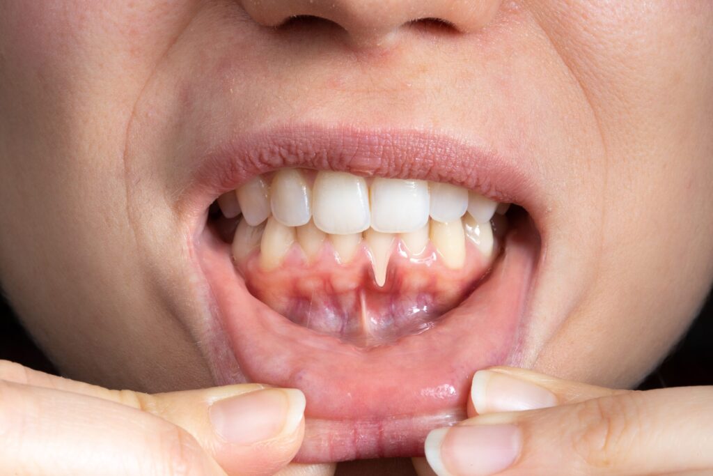 Preparing for teeth whitening with receding gums Southampton